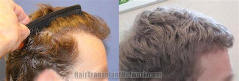 Dr Timothy Carman Hair Restoration Surgical Procedure Before And After