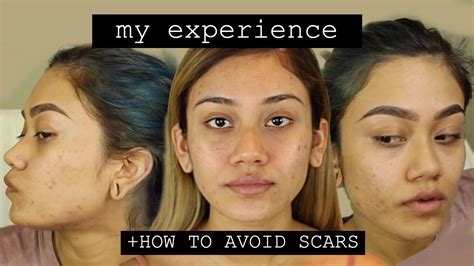 How I Got Rid Of My Acne Affordable Youtube