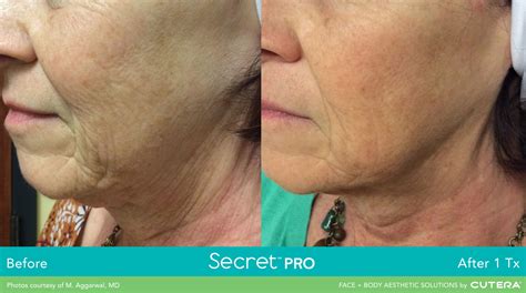 Secret Rf Microneedling Treatment In Stamford Ct