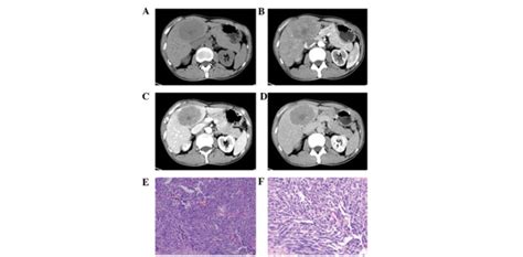 Poorly Differentiated Neuroendocrine Carcinoma In A 57 Year Old Male Download Scientific