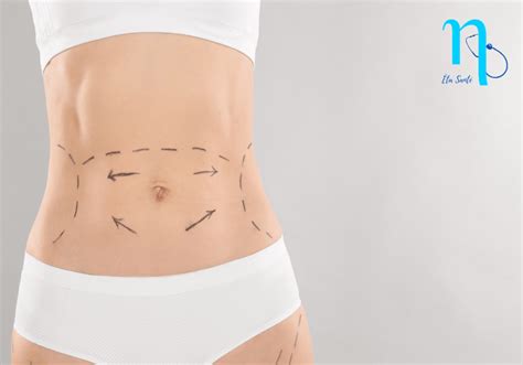 Prix Abdominoplastie Tunisie Eta Sante