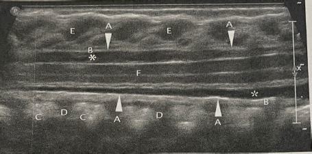 Ch Neonatal Spine Flashcards Quizlet