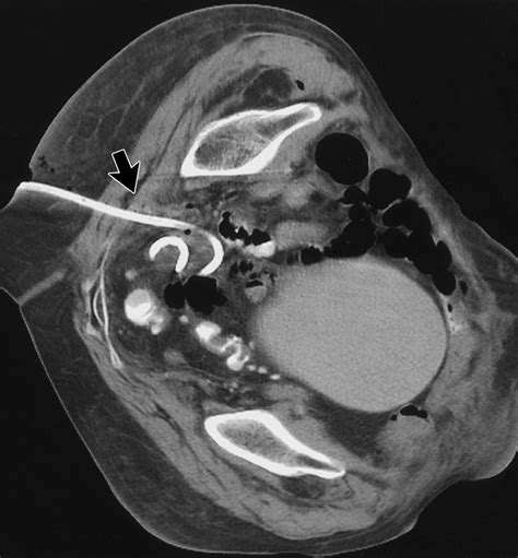 Ct Guided Transgluteal Drainage Of Deep Pelvic Abscesses Indications