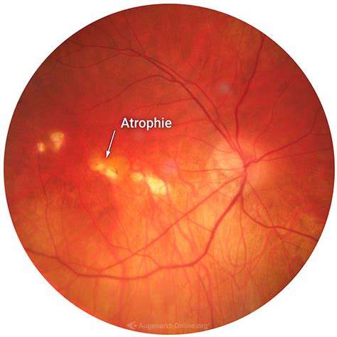 Chorioretinale Atrophie Netzhaut Fundus Trainer