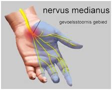 Carpaal Tunnel Syndroom Bravis Ziekenhuis