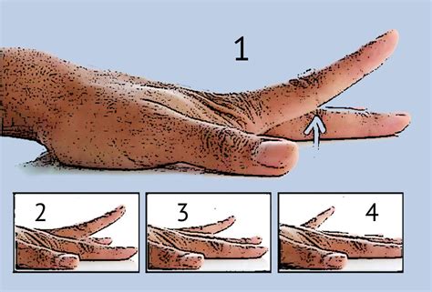 Physical Therapy Finger Exercises After Injury Fort Worth Hand Center