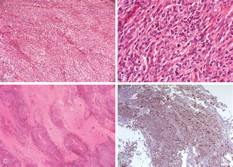 Management Of Atypical And Anaplastic Meningiomas Clinical Gate