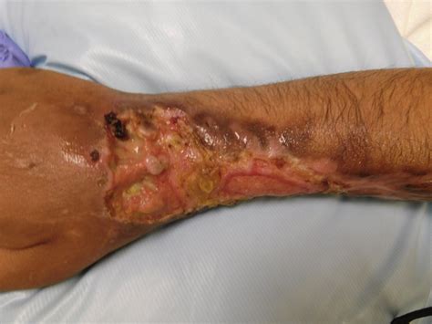 Krokodil Drug Skin Effects