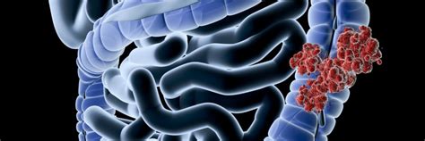 Tumore Al Colon I Sintomi E Le Cure Per Prevenire