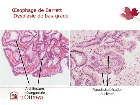 PPT Conférence anatomo clinique Œsophage de Barrett carcinome