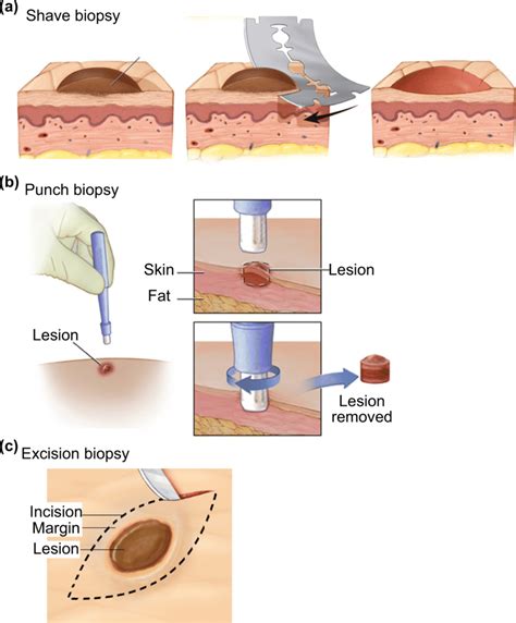 Skin Biopsy Is The Current Standard For Skin Conditions Diagnosis The Download Scientific