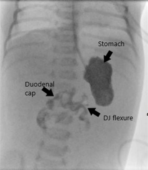 Fluoroscopic Image Of The Upper Gi Contrast Examination Shows Normal Download Scientific