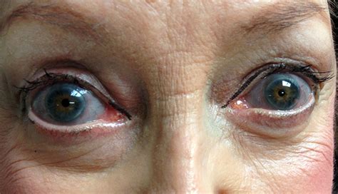 Osteogenesis Imperfecta Blue Sclera