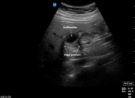 Gallbladder Ultrasound