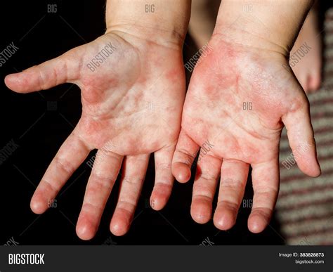 Red Rash On Hands Image Photo Free Trial Bigstock