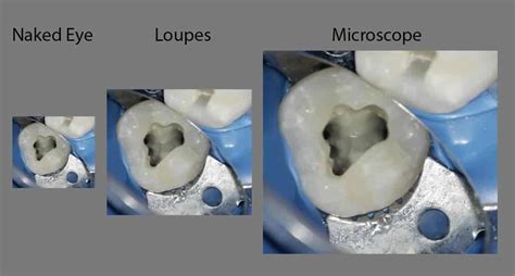 Microscopic Root Canal Treatment In Hyderabad Fms Dental