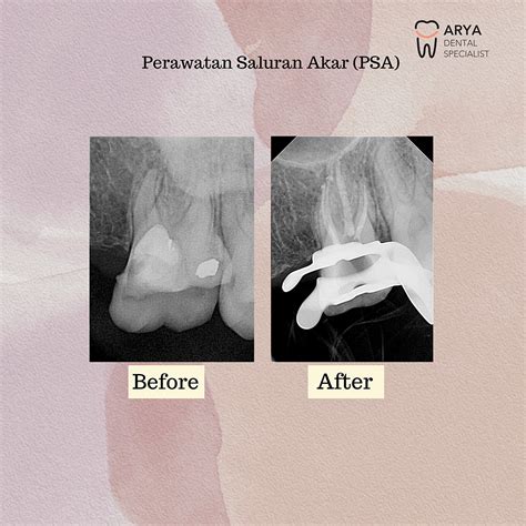 Perawatan Saluran Akar – Dental Clinic Specialist