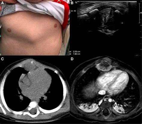 Frontiers Case Report Desmoid Fibromatosis In The Mediastinum Of A