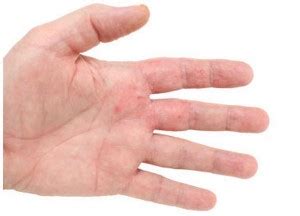 HIV Rash - Symptoms, Characteristics, Pictures and Treatment