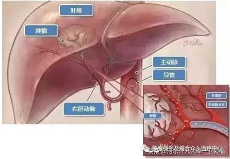 肝癌的微創介入治療（介入栓塞射頻消融） 運城市第一醫院 每日頭條