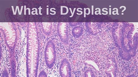 What Is Dysplasia Pathology Mini Tutorial YouTube