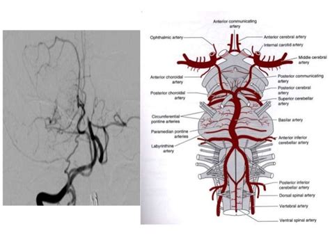 Basilar artery thrombosis clinical meet