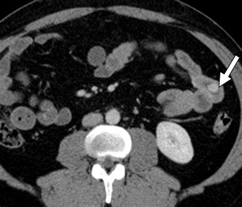 Jejunal Carcinoid In A 51 Year Old Man Axial Multidetector Ct Image Of