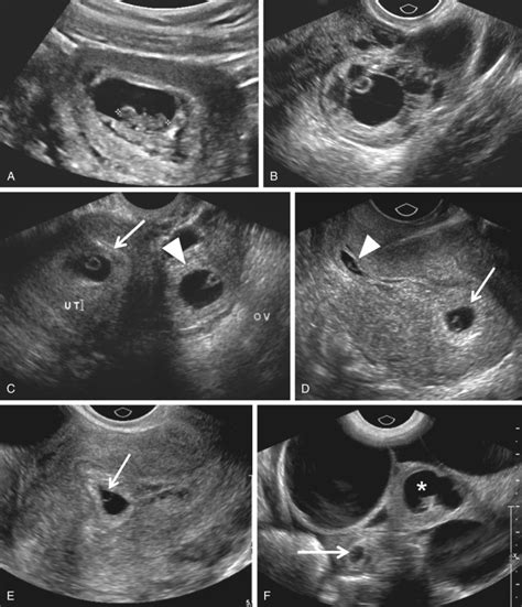 Ectopic Pregnancy Obgyn Key