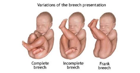 Breech Presentation Longitudinal Lie