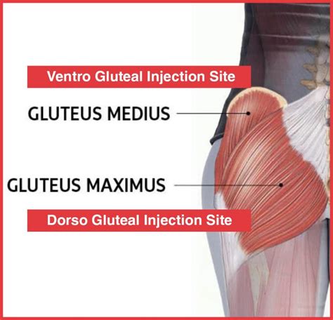 How To Do Ventrogluteal Injection - Glute Injection Guide And Demo - The TRT Hub