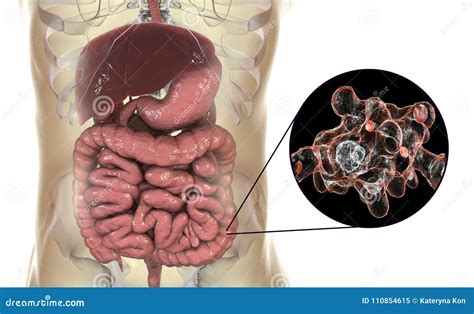 Infección Del Protozoario Del Histolytica Del Entamoeba Del Intestino Grueso Stock De