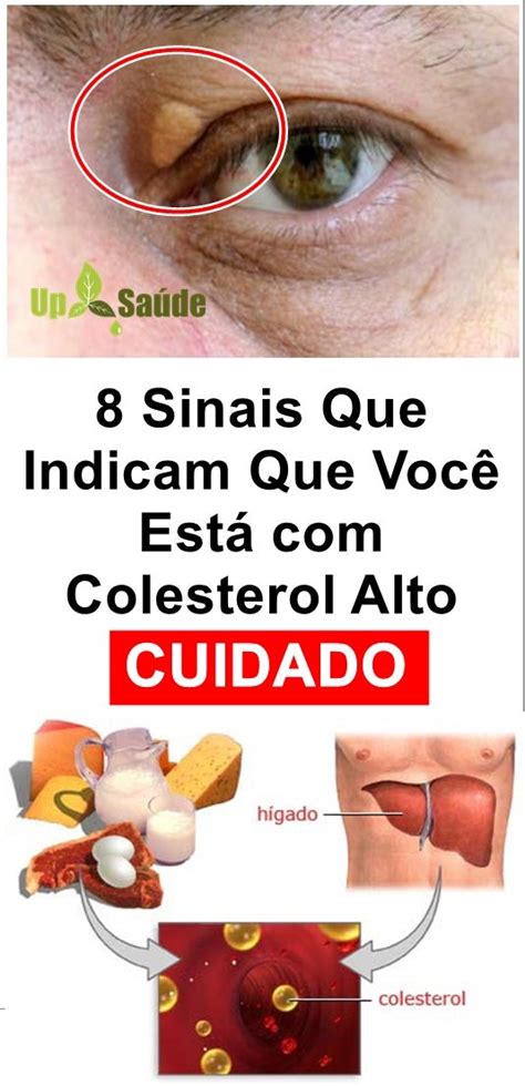 8 Sinais Que Indicam Que Você Está Com Colesterol Alto Colesterol