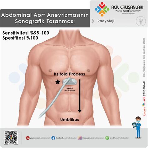 Abdominal Aort Anevrizmasına Acil Yaklaşım Acil Çalışanları