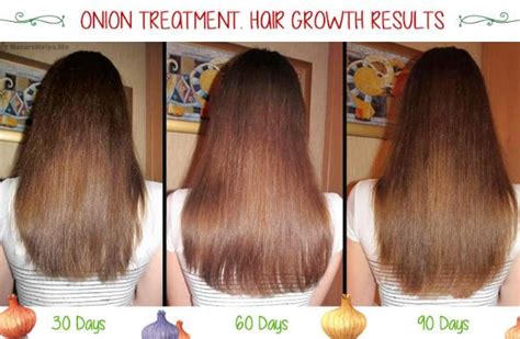 Onion Juice For Hair Growth How To Use Reviews Before And After