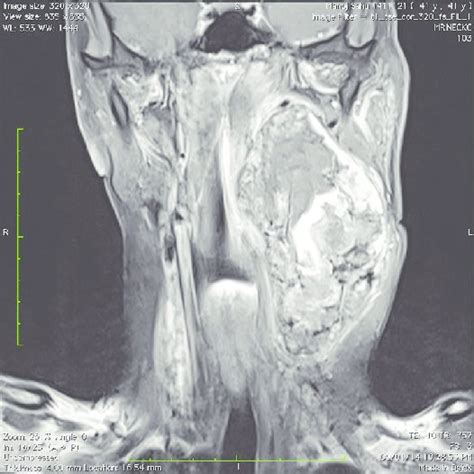 Contrast Enhanced Magnetic Resonance Imaging T1 Weighted Fat Saturated