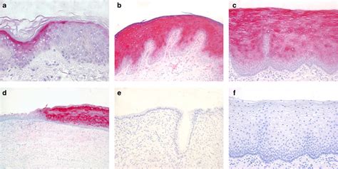 Psoriasin S A Is A Major Escherichia Coli Cidal Factor Of The