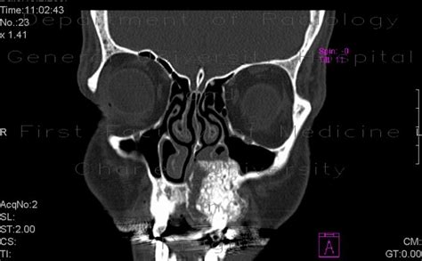 Radiology Case Fibrous Dysplasia Of Maxilla