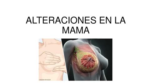 ALTERACIONES EN LA MAMA Ana Lizbeth De La Cruz Nocelo UDocz