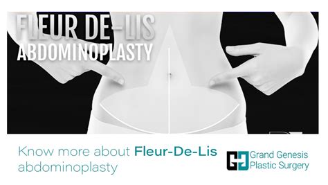 Fleur de lis tummy tuck procedure - polfgray