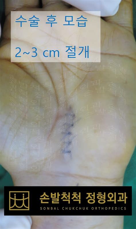 손발척척 정형외과 수술센터 수술센터 수술센터 수근관증후군 손목터널증후군 손저림목디스크손목 수술