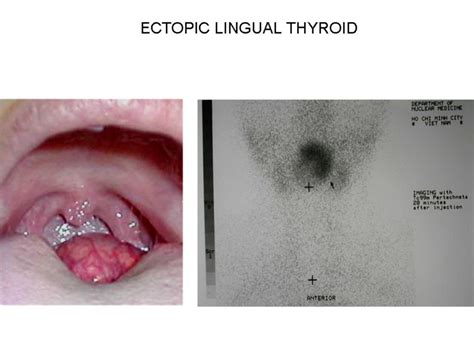 Ectopic Thyroid