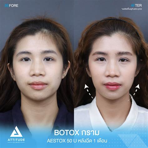 รีวิวฉีดโบท็อกซ์กราม Aestox จำนวน 50 Unit ของคุณพลอย ปรับรูปหน้าให้ดู