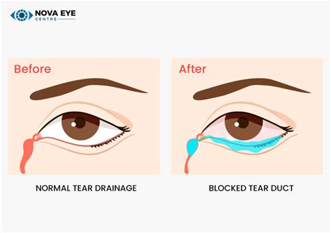 DCR Surgery Treatment For Blocked Tear Ducts Nova Eye Centre