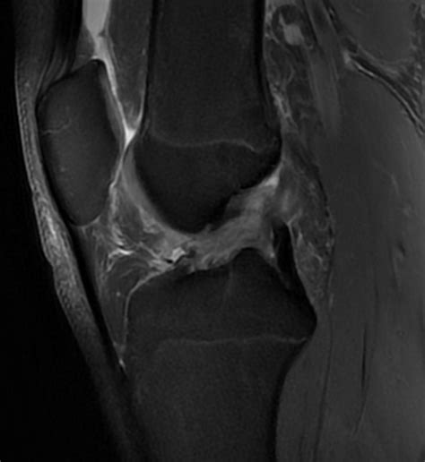 Comment Savoir Si J Ai Une Rupture Du Ligament Crois Ant Rieur