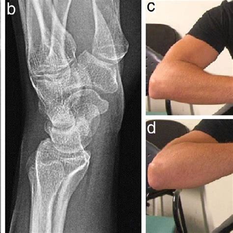 The initial radiograph showing a fracture of the intercondylar eminence ...