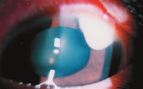 Slit Lamp Photograph Demonstrating Exudates In Superior Anterior