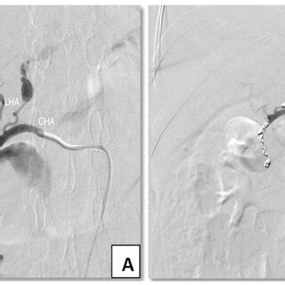 (A) Visceral angiography showing the gastroduodenal artery (GDA)... | Download Scientific Diagram