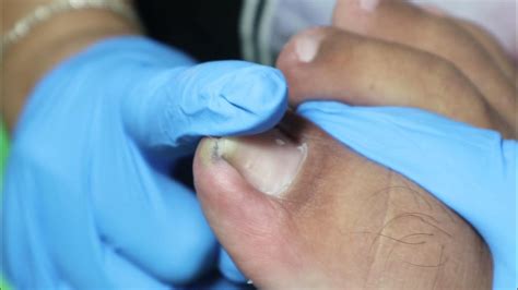 Ep3277 Ingrown Toenail Removal 👣 เจ็บจนนิ้วสั่น 😷 Clip From