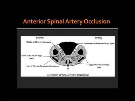 Complete Occlusion of Anterior Spinal Artery - YouTube