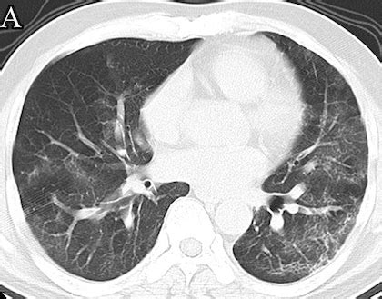 L embolie pulmonaire aigüe comme complication du COVID 19